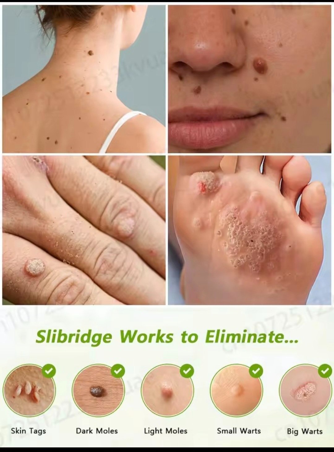 Phototherapy wart removal - 2